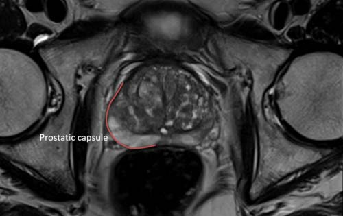 mpMRI before biopsy